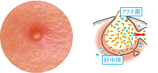 黃ニキビのイメージ画像