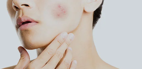 ニキビで悩むメンズの画像