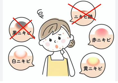 ニキビの種類と原因のイメージ画像